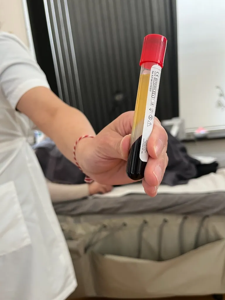 PRP-rör med plättrik plasma